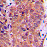 FOXO1 / FKHR Antibody - Immunohistochemical analysis of FOXO1 (pS319) staining in human breast cancer formalin fixed paraffin embedded tissue section. The section was pre-treated using heat mediated antigen retrieval with sodium citrate buffer (pH 6.0). The section was then incubated with the antibody at room temperature and detected using an HRP conjugated compact polymer system. DAB was used as the chromogen. The section was then counterstained with hematoxylin and mounted with DPX.