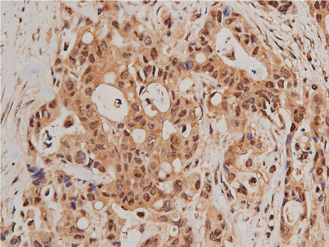 FOXO1 / FKHR Antibody - 1:200 staining human colon carcinoma tissue by IHC-P. The tissue was formaldehyde fixed and a heat mediated antigen retrieval step in citrate buffer was performed. The tissue was then blocked and incubated with the antibody for 1.5 hours at 22°C. An HRP conjugated goat anti-rabbit antibody was used as the secondary.
