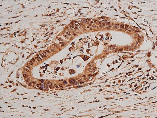 FOXO1 / FKHR Antibody - 1:50 staining human colon carcinoma tissue by IHC-P. The tissue was formaldehyde fixed and a heat mediated antigen retrieval step in citrate buffer was performed. The tissue was then blocked and incubated with the antibody for 1.5 hours at 22°C. An HRP conjugated goat anti-rabbit antibody was used as the secondary.