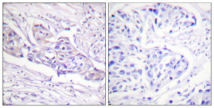 FOXO1 / FKHR Antibody - Immunohistochemistry analysis of paraffin-embedded human breast carcinoma, using FOXO1A (Phospho-Ser329) Antibody. The picture on the right is blocked with the phospho peptide.