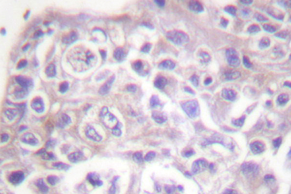 FOXO1 / FKHR Antibody - IHC of FKHR (T323) pAb in paraffin-embedded human breast carcinoma tissue.