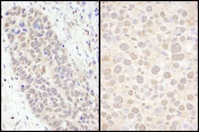 FOXO3 / FOXO3A Antibody - Detection of Human and Mouse Immunohistochemistry. Sample: FFPE sections of human ovarian carcinoma (left) and mouse renal cell carcinoma (right). Antibody: Affinity purified rabbit anti-No. Lot2) used at a dilution of 1:500 (2 ug/ml). Detection: DAB.