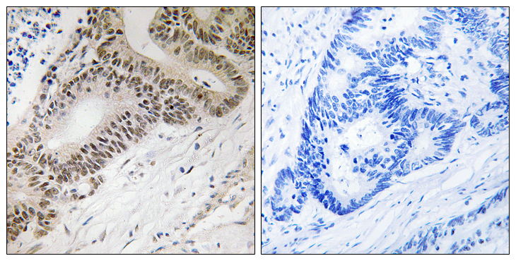 FOXO3 / FOXO3A Antibody - Immunohistochemistry analysis of paraffin-embedded human colon carcinoma tissue, using FOXO3A Antibody. The picture on the right is blocked with the synthesized peptide.