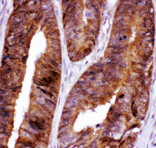 FOXO3 / FOXO3A Antibody - FOXO3A antibody IHC-paraffin. IHC(P): Human Intestinal Cancer Tissue.