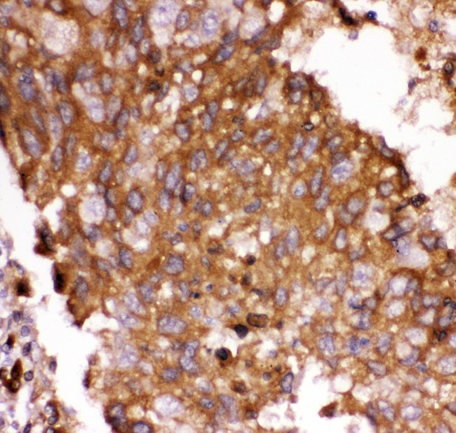 FOXO3 / FOXO3A Antibody - FOXO3A antibody IHC-paraffin. IHC(P): Human Lung Cancer Tissue.