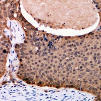 FOXO3 / FOXO3A Antibody - Immunohistochemical analysis of FOXO3 staining in human breast cancer formalin fixed paraffin embedded tissue section. The section was pre-treated using heat mediated antigen retrieval with sodium citrate buffer (pH 6.0). The section was then incubated with the antibody at room temperature and detected using an HRP conjugated compact polymer system. DAB was used as the chromogen. The section was then counterstained with haematoxylin and mounted with DPX.
