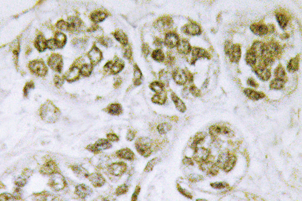 FOXO3 / FOXO3A Antibody - IHC of p-FoxO3 (S253) pAb in paraffin-embedded human breast carcinoma tissue.