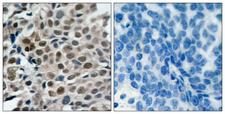 FOXO3 / FOXO3A Antibody - Immunohistochemistry analysis of paraffin-embedded human breast carcinoma, using FKHRL1 (Phospho-Ser253) Antibody. The picture on the right is blocked with the phospho peptide.
