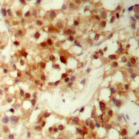 FOXO3 / FOXO3A Antibody - Immunohistochemical analysis of FOXO3 (pS253) staining in human prostate cancer formalin fixed paraffin embedded tissue section. The section was pre-treated using heat mediated antigen retrieval with sodium citrate buffer (pH 6.0). The section was then incubated with the antibody at room temperature and detected using an HRP conjugated compact polymer system. DAB was used as the chromogen. The section was then counterstained with hematoxylin and mounted with DPX.