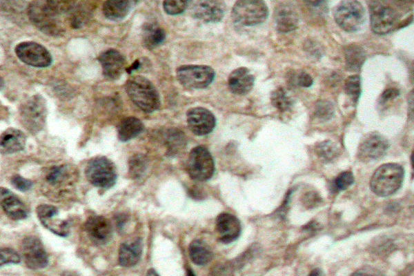 FOXO3 / FOXO3A Antibody - IHC of FoxO3 (P247) pAb in paraffin-embedded human breast carcinoma tissue.