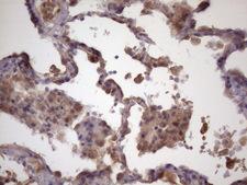 FOXO4 / AFX1 Antibody - Immunohistochemical staining of paraffin-embedded Carcinoma of Human lung tissue using anti-FOXO4 mouse monoclonal antibody. (Heat-induced epitope retrieval by 1mM EDTA in 10mM Tris buffer. (pH8.5) at 120 oC for 3 min. (1:150)