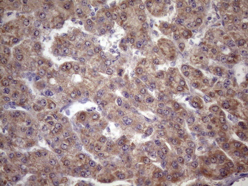 FOXO4 / AFX1 Antibody - Immunohistochemical staining of paraffin-embedded Carcinoma of Human liver tissue using anti-FOXO4 mouse monoclonal antibody. (Heat-induced epitope retrieval by 1mM EDTA in 10mM Tris buffer. (pH8.5) at 120 oC for 3 min. (1:150)