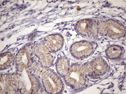 FOXO4 / AFX1 Antibody - Immunohistochemical staining of paraffin-embedded Carcinoma of Human pancreas tissue using anti-FOXO4 mouse monoclonal antibody. (Heat-induced epitope retrieval by 1mM EDTA in 10mM Tris buffer. (pH8.5) at 120 oC for 3 min. (1:150)