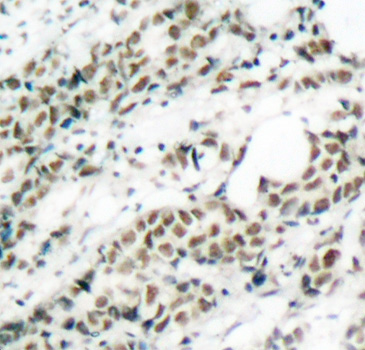 FOXO4 / AFX1 Antibody - Immunohistochemical analysis of paraffin-embedded human breast carcinoma tissue.