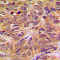 FOXO4 / AFX1 Antibody - Immunohistochemical analysis of FOXO4 (pS197) staining in human breast cancer formalin fixed paraffin embedded tissue section. The section was pre-treated using heat mediated antigen retrieval with sodium citrate buffer (pH 6.0). The section was then incubated with the antibody at room temperature and detected using an HRP conjugated compact polymer system. DAB was used as the chromogen. The section was then counterstained with hematoxylin and mounted with DPX.