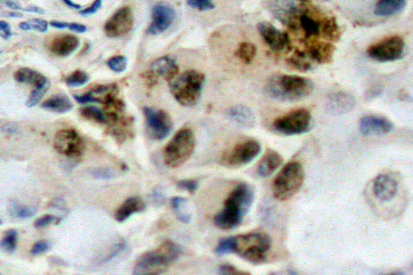 FOXO4 / AFX1 Antibody - IHC of FoxO4 (P191) pAb in paraffin-embedded human breast carcinoma tissue.