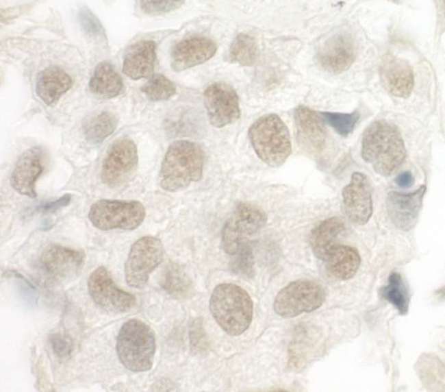 FOXP1 Antibody - Detection of Human FOXP1 by Immunohistochemistry. Sample: FFPE section of human breast carcinoma. Antibody: Affinity purified rabbit anti-FOXP1 used at a dilution of 1:250.