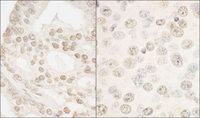 FOXP1 Antibody - Detection of Human and Mouse FOXP1 by Immunohistochemistry. Sample: FFPE section of human prostate carcinoma (left) and mouse hybridoma tumor. Antibody: Affinity purified rabbit anti-FOXP1 (-1) used at a dilution of 1:1000 (1 ug/ml). Detection: DAB.