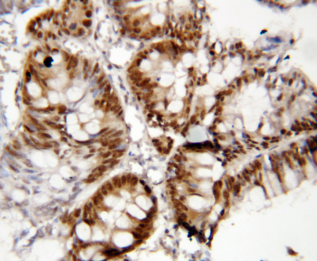 FOXP1 Antibody - FOXP1 antibody. IHC(P): Human Rectal Cancer Tissue.