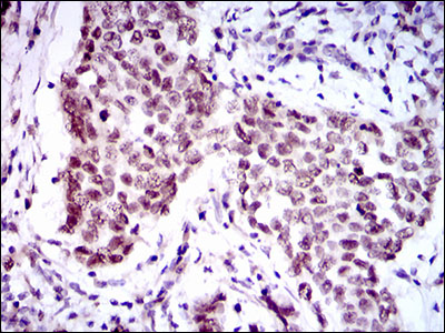 FOXP1 Antibody - IHC of paraffin-embedded breast cancer tissues using FOXP1 mouse monoclonal antibody with DAB staining.