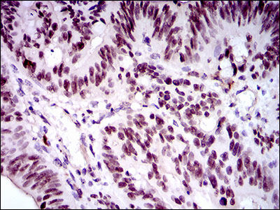FOXP1 Antibody - IHC of paraffin-embedded rectum cancer tissues using FOXP1 mouse monoclonal antibody with DAB staining.