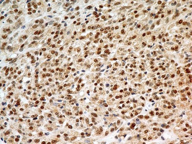 FOXP1 Antibody - Immunohistochemistry-Paraffin: FOXP1 Antibody (JC12) - IHC analysis of formalin-fixed paraffin-embedded tissue section of malignant stromal tumor of the human small bowel using mouse monoclonal FOXP1 antibody (clone JC12) at 5 ug/ml concentration. The carcinoma cells developed an expected and specific strong nuclear with mild cytoplasmic immunopositivity for FOXP1 protein.