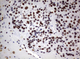 FOXP1 Antibody - IHC of paraffin-embedded Adenocarcinoma of Human breast tissue using anti-FOXP1 mouse monoclonal antibody. (heat-induced epitope retrieval by 1 mM EDTA in 10mM Tris, pH8.5, 120°C for 3min).