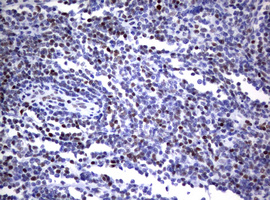 FOXP1 Antibody - IHC of paraffin-embedded Human lymphoma tissue using anti-FOXP1 mouse monoclonal antibody. (heat-induced epitope retrieval by 1 mM EDTA in 10mM Tris, pH8.5, 120°C for 3min).