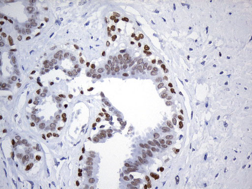 FOXP1 Antibody - Immunohistochemical staining of paraffin-embedded Human breast tissue within the normal limits using anti-FOXP1 mouse monoclonal antibody. (Heat-induced epitope retrieval by 1mM EDTA in 10mM Tris buffer. (pH8.5) at 120°C for 3 min. (1:75)
