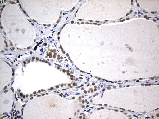 FOXP1 Antibody - Immunohistochemical staining of paraffin-embedded Human thyroid tissue within the normal limits using anti-FOXP1 mouse monoclonal antibody. (Heat-induced epitope retrieval by 1mM EDTA in 10mM Tris buffer. (pH8.5) at 120°C for 3 min. (1:75)