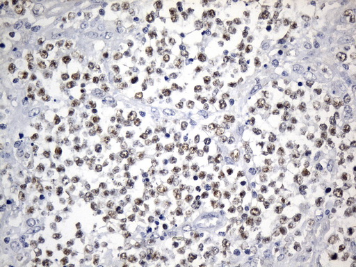 FOXP1 Antibody - Immunohistochemical staining of paraffin-embedded Human lymphoma tissue using anti-FOXP1 mouse monoclonal antibody. (Heat-induced epitope retrieval by 1mM EDTA in 10mM Tris buffer. (pH8.5) at 120°C for 3 min. (1:75)