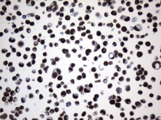 FOXP1 Antibody - Immunohistochemical staining of paraffin-embedded MDA-MB-453 cell pellets using anti-FOXP1 mouse monoclonal antibody. (Heat-induced epitope retrieval by 1mM EDTA in 10mM Tris buffer. (pH8.0) at 120°C for 2.5 min(1:75)