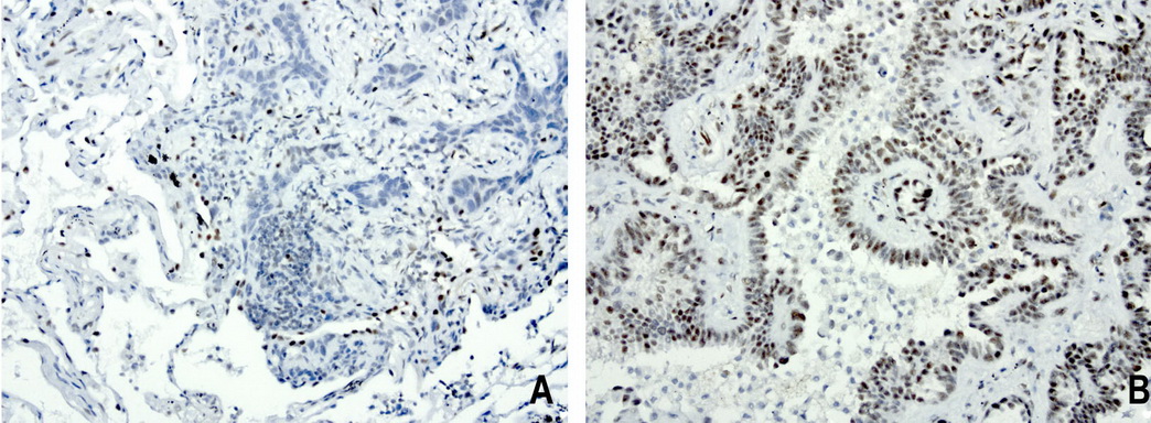 FOXP1 Antibody - Immunohistochemical staining of paraffin-embedded human lung cancer using anti-FOXP1 clone UMAB89 mouse monoclonal antibody at 1:200 dilution of 1.0 mg/mL using Polink2 Broad HRP DAB for detection.requires HIER with with citrate pH6.0 at 110C for 3 min using pressure chamber/cooker. The panel A shows negative tumor cells of lung carcinoma and panel B strong nuclear staining in the tumor cells.