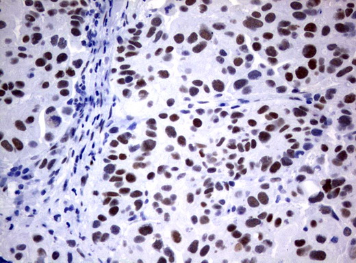 FOXP1 Antibody - Immunohistochemical staining of paraffin-embedded Carcinoma of Human bladder tissue using anti-FOXP1 mouse monoclonal antibody.  heat-induced epitope retrieval by 1 mM EDTA in 10mM Tris, pH8.0, 120C for 3min)