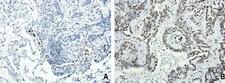 FOXP1 Antibody - Immunohistochemical staining of paraffin-embedded human lung cancer using anti-FOXP1 clone UMAB89 mouse monoclonal antibody at 1:200 dilution of 1.0 mg/mL using Polink2 Broad HRP DAB for detection.requires HIER with with citrate pH6.0 at 110C for 3 min using pressure chamber/cooker. The panel A shows negative tumor cells of lung carcinoma and panel B strong nuclear staining in the tumor cells.