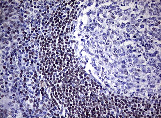 FOXP1 Antibody - Immunohistochemical staining of paraffin-embedded Human tonsil using anti-FOXP1 mouse monoclonal antibody.  heat-induced epitope retrieval by 1 mM EDTA in 10mM Tris, pH8.0, 120C for 3min)