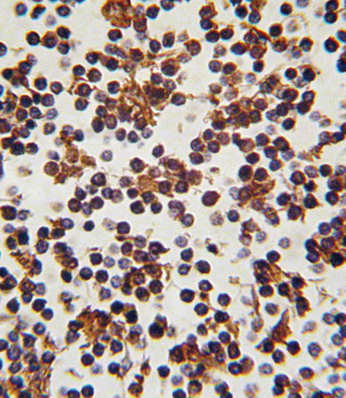 FOXP3 Antibody - Formalin-fixed and paraffin-embedded human lymph tissue reacted with FOXP3 antibody , which was peroxidase-conjugated to the secondary antibody, followed by DAB staining. This data demonstrates the use of this antibody for immunohistochemistry; clinical relevance has not been evaluated.