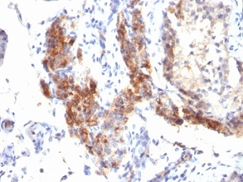 FOXP3 Antibody - Formalin-fixed, paraffin-embedded human testicular carcinoma stained with FOXP3 antibody (SPM579).  This image was taken for the unmodified form of this product. Other forms have not been tested.