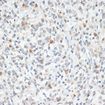 FOXP3 Antibody - Immunohistochemistry of paraffin-embedded human gastric cancer using FOXP3 antibody at dilution of 1:100 (40x lens).