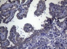 FOXQ1 Antibody - Immunohistochemical staining of paraffin-embedded Carcinoma of Human thyroid tissue using anti-FOXQ1 mouse monoclonal antibody. (Heat-induced epitope retrieval by 1mM EDTA in 10mM Tris buffer. (pH8.5) at 120°C for 3 min. (1:150)