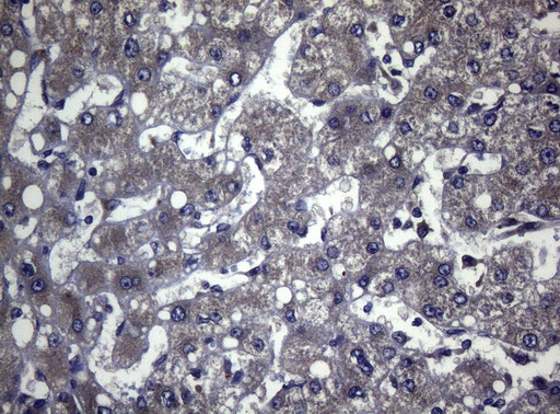 FOXQ1 Antibody - Immunohistochemical staining of paraffin-embedded Carcinoma of Human liver tissue using anti-FOXQ1 mouse monoclonal antibody. (Heat-induced epitope retrieval by 1mM EDTA in 10mM Tris buffer. (pH8.5) at 120°C for 3 min. (1:150)