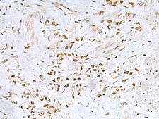 FOXQ1 Antibody - Immunohistochemistry of paraffin-embedded Human gastric cancer tissue  using FOXQ1 Polyclonal Antibody at dilution of 1:25(×200)