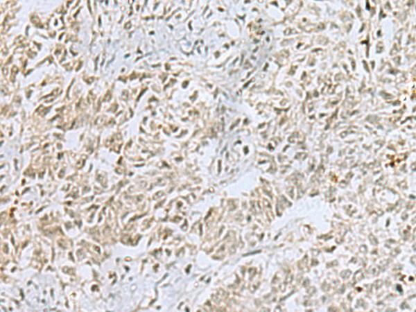 FOXQ1 Antibody - Immunohistochemistry of paraffin-embedded Human ovarian cancer tissue  using FOXQ1 Polyclonal Antibody at dilution of 1:25(×200)