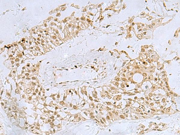 FOXQ1 Antibody - Immunohistochemistry of paraffin-embedded Human colorectal cancer tissue  using FOXQ1 Polyclonal Antibody at dilution of 1:30(×200)