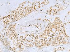 FOXQ1 Antibody - Immunohistochemistry of paraffin-embedded Human colorectal cancer tissue  using FOXQ1 Polyclonal Antibody at dilution of 1:30(×200)