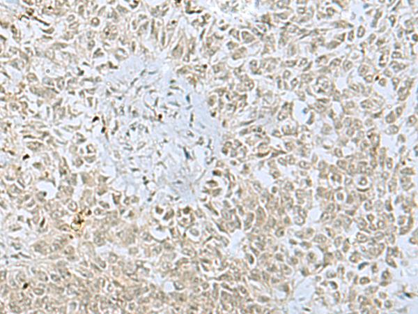 FOXQ1 Antibody - Immunohistochemistry of paraffin-embedded Human ovarian cancer tissue  using FOXQ1 Polyclonal Antibody at dilution of 1:30(×200)
