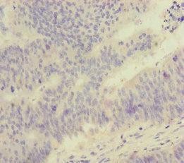 FOXRED1 Antibody - Immunohistochemistry of paraffin-embedded human colon cancer at dilution of 1:100