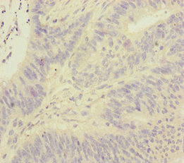 FOXRED1 Antibody - Immunohistochemistry of paraffin-embedded human colon cancer at dilution of 1:100