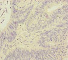 FOXRED1 Antibody - Immunohistochemistry of paraffin-embedded human colon cancer at dilution of 1:100