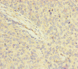 FOXRED1 Antibody - Immunohistochemistry of paraffin-embedded human ovarian cancer at dilution of 1:100